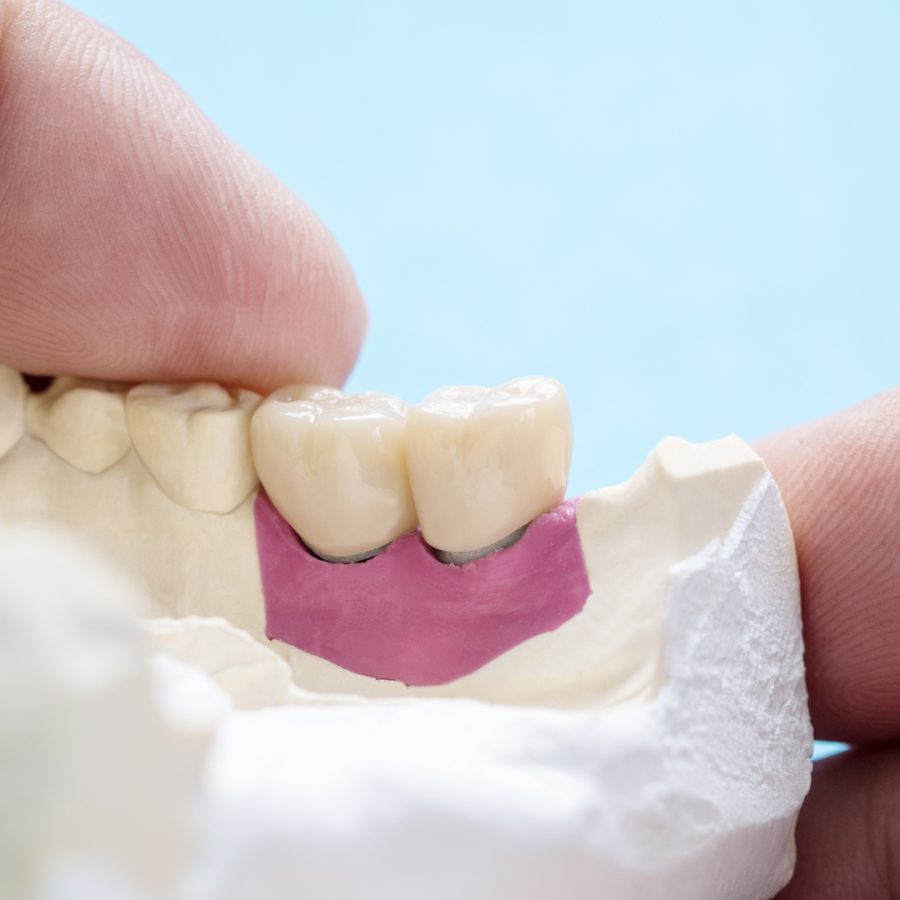 Closeup / Implant Prosthodontics or Prosthetic / Tooth crown and bridge implant dentistry equipment and model express fix restoration.